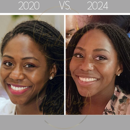 Before and after facial appearance showing improved skin rejuvenation results from PRP therapy