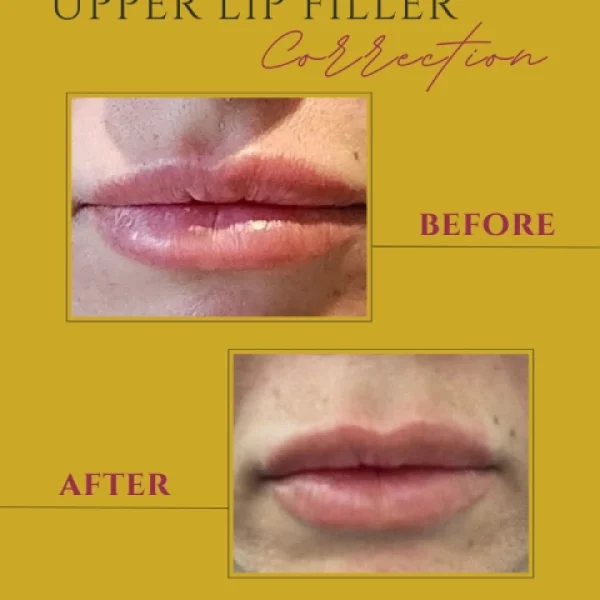 Corrective Lip Filler Brooklyn female client with uneven lips corrected with careful lip injections