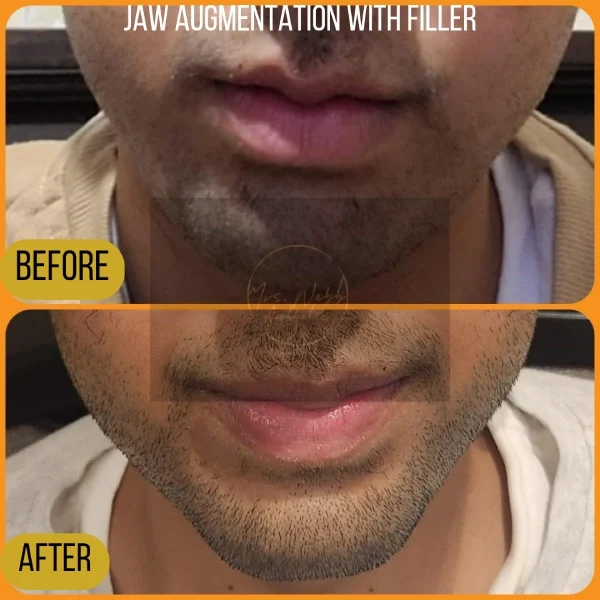 Jaw Filler Augmentation Dark skinned male client before and after receiving jaw filler