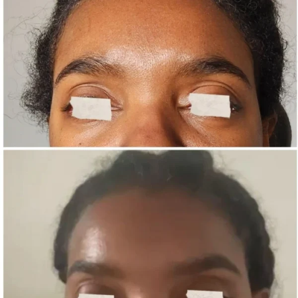 Eyebrow Lift Black female client before and after treatment with Botox.