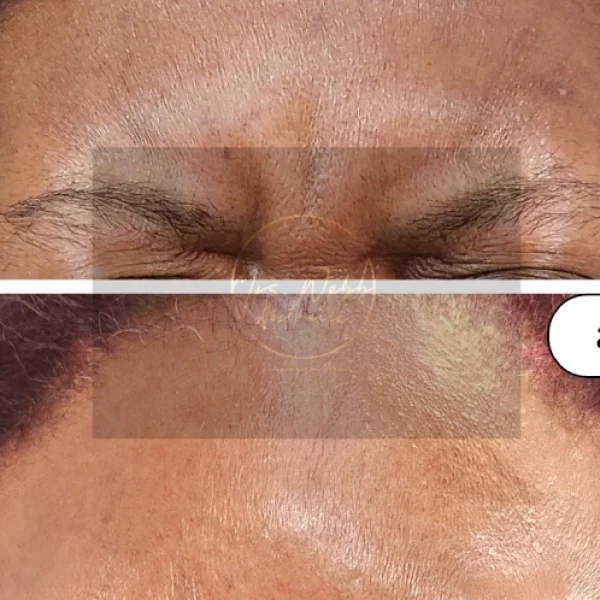 Glabella Treatment Black female client before and after treatment with Botox.