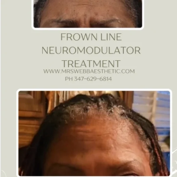 Glabella Treatment Black female client before and after treatment with Botox.