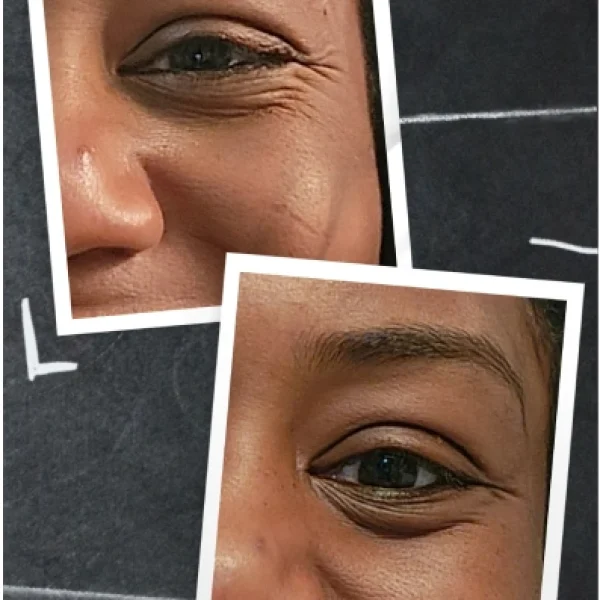 Crows Feet Botox Black female client before and after glabella treatment with Botox