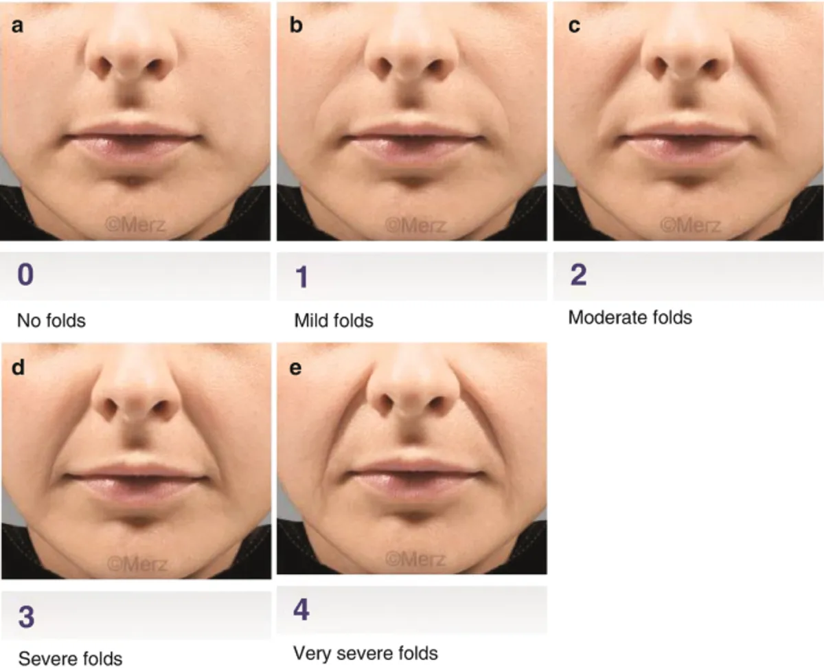 Stages of Nasolabial Folds on Face | Mrs Webb Aesthetic in Brooklyn NY