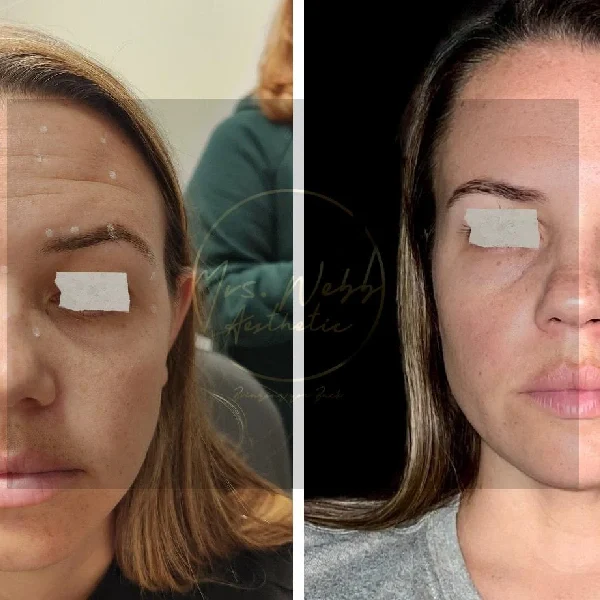 Cheek Filler Before and After Results at Mrs. Webb Aesthetics