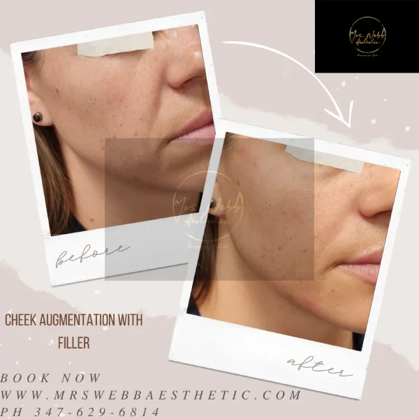 Facial Filler Gallery