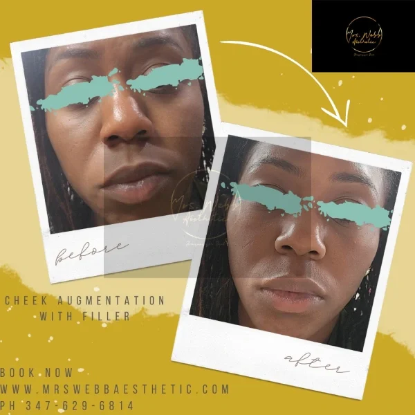 Facial Filler Gallery v in Brooklyn NY