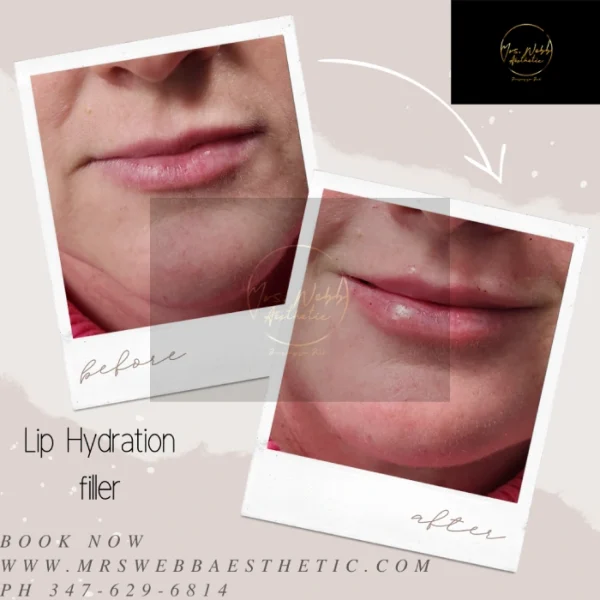 Webb Aesthetics Lips Gallery