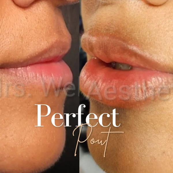 Lip Filler Before and After Images | Webb Aesthetic