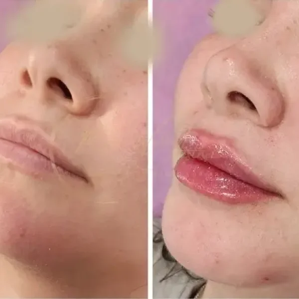 Lip Filler Before and After