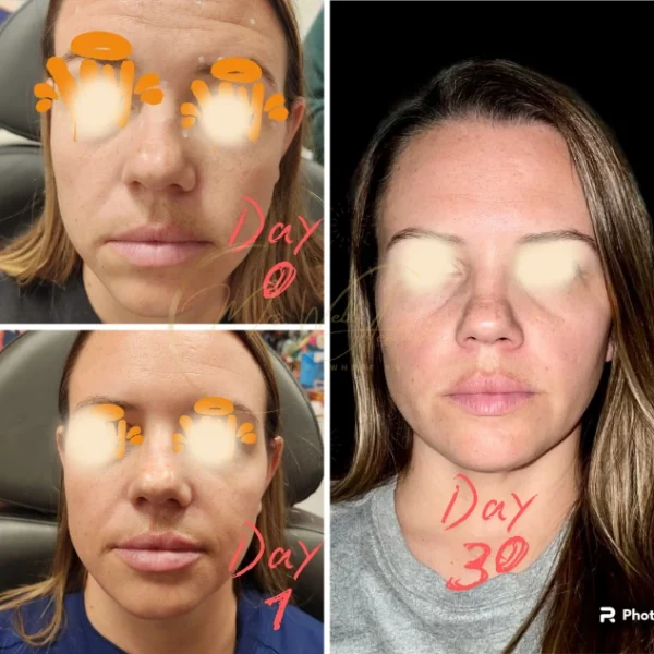 Lip Filler Before and After Images | Mrs. Webb Aesthetic