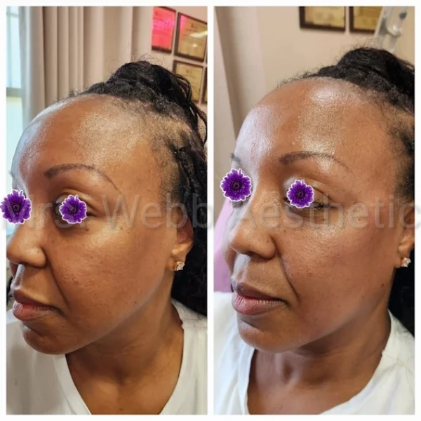 Lip Filler Before and After Images