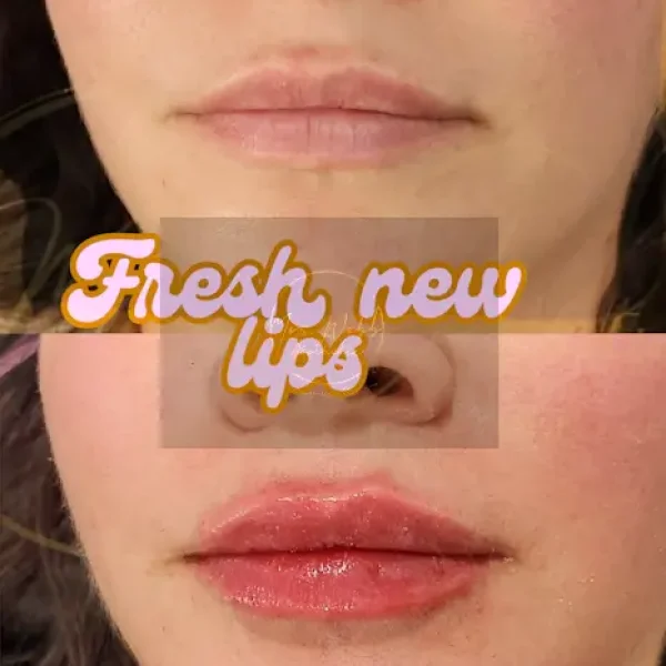 Lip Filler Before After